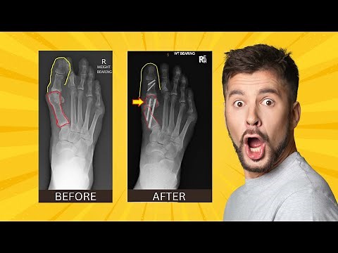 Minimally Invasive BUNION SURGERY: How is it Done?