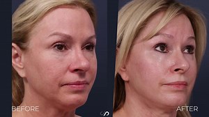 Lower Face & Neck Lift