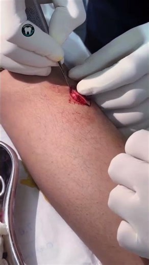 Wart #surgery #medical