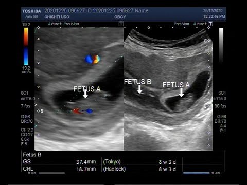 Fetus papyraceus with a pregnancy of about 8 weeks 2 days.