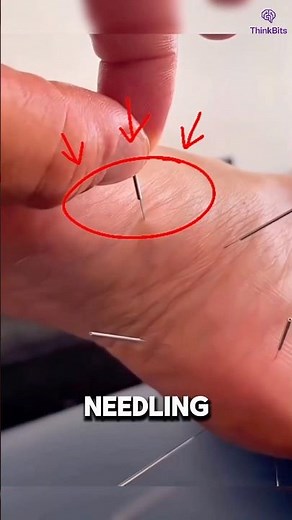 Dry Needling: Instant Relief for Tight Muscles? 💉