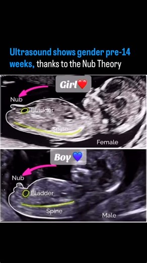 Artificial Intelligence (AI) | Technology | News & Prompts on Instagram: "Science confirms what parents have been guessing for decades; baby gender prediction is now possible even before 14 weeks. Ultrasound meets precision, powered by the Nub Theory, changing how early families can connect with their unborn child. In today’s reel, we uncover how sonographers and ultrasound imaging can now identify fetal gender by analyzing the genital tubercle angle; commonly known as the Nub Theory. What was o