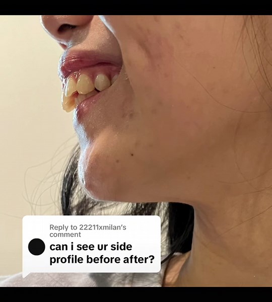 Replying to @22211xmilan here you go ☺️ #overbite #overbitecheck #overbiteteeth #overbitecorrection #jawsurgery #overjetcorrection #overjet #braces #bracesoff #bracestips #bracestok