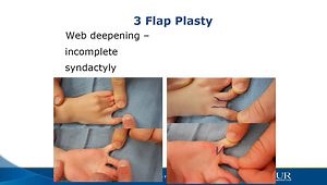 Local Flaps for Hand Coverage