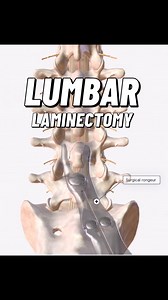397 reactions · 13 comments | A lumbar laminectomy is a surgical...