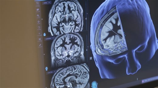 American heart and stroke associations update guidelines to prevent first strokes