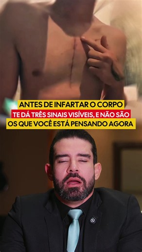 Muita gente acredita que o infarto acontece de uma hora para outra, sem qualquer aviso. Mas, em alguns casos, o organismo pode dar sinais que passam despercebidos por meses ou até anos. O problema é que a maioria das pessoas não sabe reconhecê-los e perde a oportunidade de investigar precocemente. No vídeo, eu explico quais são esses três sinais, por que eles podem aparecer antes de um infarto e quando eles merecem atenção médica. 📚 Referências científicas: American Heart Association (AHA); Eur