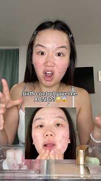 People still tell me to go back on birth control 🫠 #acne #hormonalacne #birthcontrol