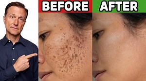 249K views · 7.8K reactions | How to Get Rid of Hyperpigmentation (Aging or Dark Spots) Learn what causes hyperpigmentation and how to get rid of hyperpigmentation. | Dr. Eric Berg | Facebook