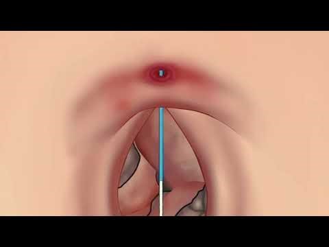 Belly button cleaning asmr sound #animation #asmr