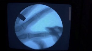 153K views · 569 reactions | Cracking knuckles under a fluoroscope | Inverse | Facebook