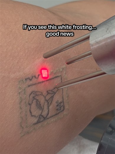Understanding Tattoo Removal: What the Frosting Reaction Means