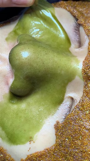 Chăm sóc da mụn và da nhờn tại LQSPA & Academy