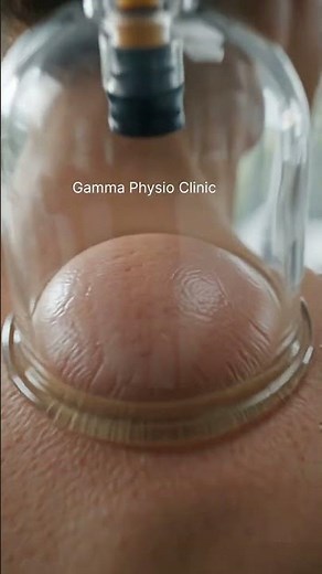 🔥 How Does Cupping Therapy Work? Discover the Science Behind Pain Relief! 🔥