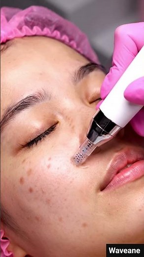 The SECRET to Clearing Acne with This Advanced Skincare Device