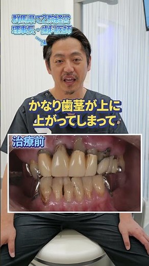 [Before & After] Treating Loose, Bleeding, and Non-functional Teeth with All-on-6 Implants!