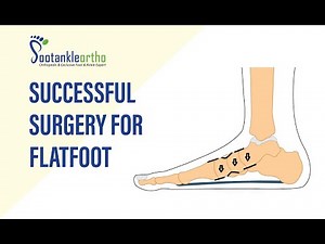 Successful Surgery for Flatfoot | Patient Shares Experience