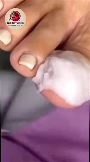 Trusted Advice to Improve Brittle Toenails Endorsed by U.S. Wellness Clinics #SimpleHealthTricks #SafeSteps #FootSupport | Bye