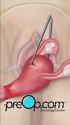 PreOp® 🌷 Vaginal Hysterectomy Prep Checklist! #preop #shorts #health 🖊️