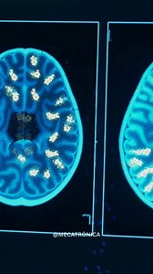CIENTÍFICOS LOGRAN RESTAURAR LA CAPACIDAD DEL CEREBRO PARA ELIMINAR LAS PLACAS RELACIONADAS CON EL ALZHEIMER Un avance prometedor en neurociencia revela que investigadores han conseguido reactivar el mecanismo natural del cerebro encargado de eliminar las placas beta-amiloides, uno de los sellos característicos del Alzheimer. Al restaurar esta función, el cerebro vuelve a limpiar los desechos que antes se acumulaban, abriendo una nueva esperanza para futuras terapias. Detalles Importantes: • El