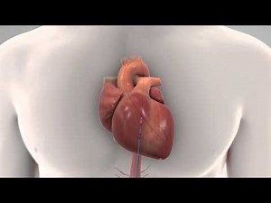 Thoratec Percutaneous Heart Pump