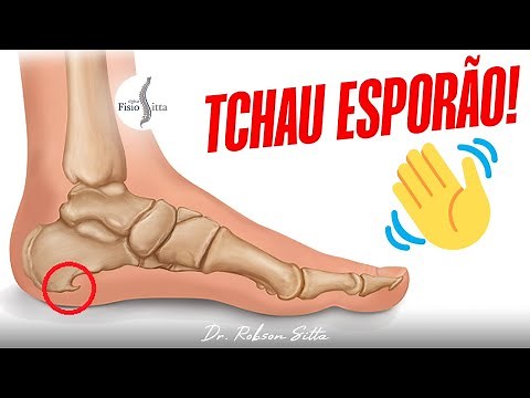 Heel Spur - Home Treatment with 4 Exercises Dr. Robson Sitta