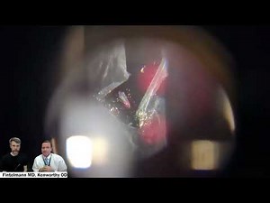 YAG capsulotomy to treat visual side effects of intraocular lenses after cataract surgery