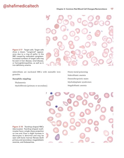 1. Target Cells Also called: Codocytes Appearance Look like a bull’s-eye / shooting target Dark center, surrounded by a clear ring, then a dark outer rim Thin RBC with increased surface area Why do they form? Excess cell membrane compared to hemoglobin Reduced hemoglobin content or altered lipid composition Seen in Thalassemia (very common) Liver disease Iron deficiency anemia Hemoglobinopathies (HbC, HbS) Post-splenectomy Lab & Exam Points ⭐ Common in microcytic anemias Often increased after sp