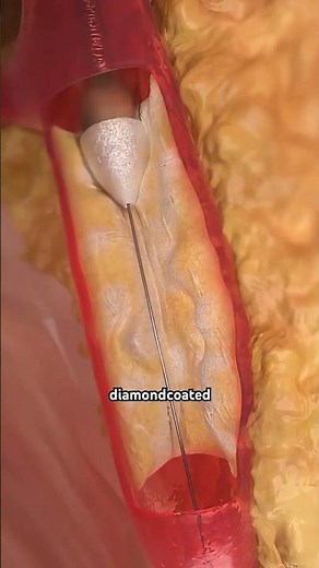 Rotational Atherectomy for plaque removal from arteries #intravascular #vulnerableplaque #stenosis