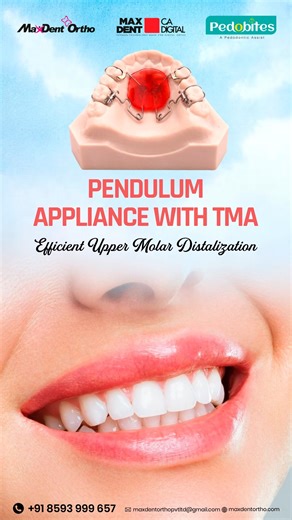 The Pendulum Appliance with TMA is designed for efficient upper molar distalization, helping achieve distal movement of the 6s even when the 7s are already present. This appliance supports clinical flexibility with both banded and bonded options, allowing practitioners to choose the approach that fits their treatment needs. Partner with Maxdent Ortho for appliance requirements. 📞 91 8593 999 657 🌐 www.maxdentortho.com 📩 maxdentorthopvtltd@gmail.com #PendulumAppliance #TMAWire #Orthodontics #M