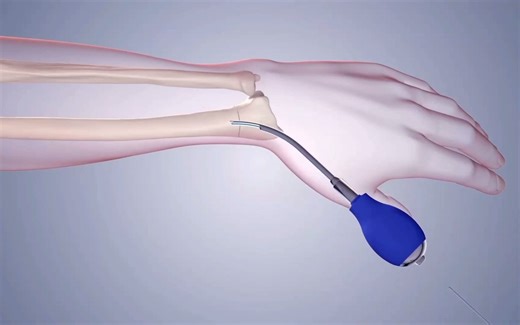 3D医学视频：桡骨远端骨折微创手术
