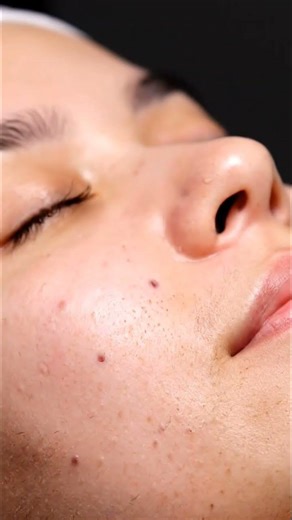 Watch Pores Lift in Real Time | Cheek Suction ASMR