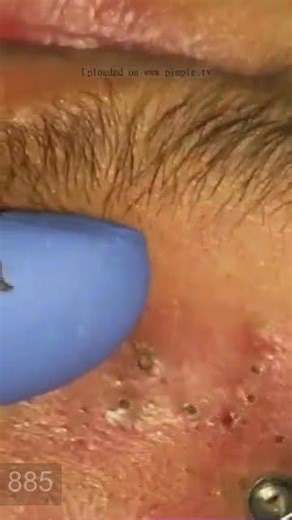 Removing large blackheads and pimples from face new 2026 #145
