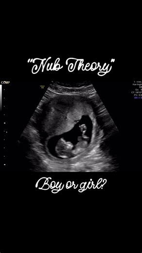 Close to Baby - 3D/4D Ultrasound Studio on Instagram: "✨ The Nub Theory Explained ✨ Ever heard of the nub theory when it comes to guessing baby’s gender on ultrasound? 🔍 What is the “nub”? The nub is a small genital tubercle seen on ultrasound between 11–14 weeks of pregnancy. 📐 How it works: • If the nub points upward at an angle greater than 30°, it may suggest a boy 💙 • If the nub is parallel or flatter to the spine, it may suggest a girl 💗 ⏳ How accurate is it? When done at the right ges