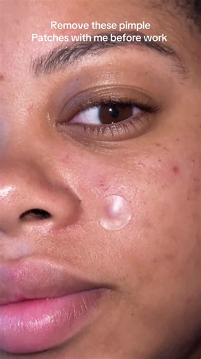 Effective Pimple Patch Removal Tips for Smooth Skin