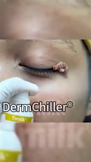 Having large patches of warts or moles on your body? Always covering them up, worried about your health? ⚠️ Note that your concerns are valid! Don't delay any longer. Try Laniska now! 🌿🔥 #wartremoval #KualaLumpur #Singapore EN1277711EN-635085