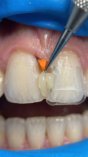 Hiding a Massive Stain Between the Two Front Teeth Instantly