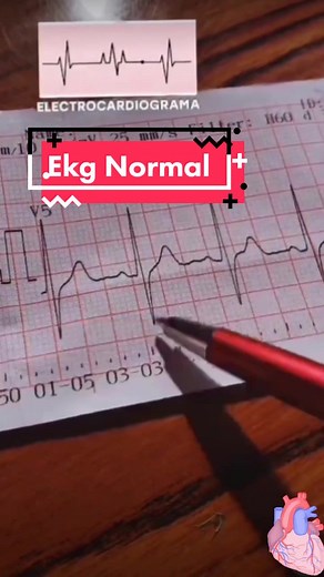 ELECTROCARDIÓGRAMA NORMAL #cardiologia #medicinainterna #fypシ #salud #medico #pageforyou #cardiology #corazon
