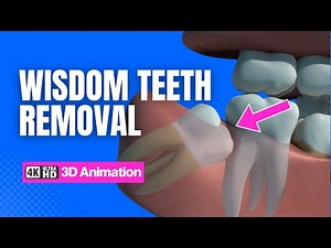 Wisdom Teeth Removal Explained | 3D Dental Animation