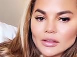 Chrissy Teigen admits she has had cheek reduction surgery