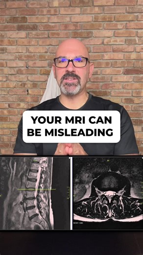 Your MRI Might Not Show the Real Problem Just because a disc looks damaged doesn’t mean it’s causing your pain. MRI findings must match: • Your symptoms • Your neurological exam • Your mechanical presentation Treating images without correlation can miss the real source. Structure matters. But function matters more. #BackPain #DiscInjury #MRIResults #SciaticaRelief #SpineHealth