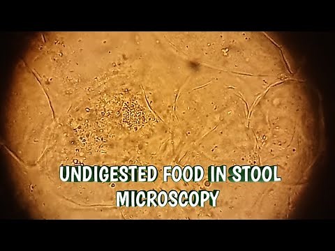 Undigested food in stool microscopy. UDF in stool microscopy at 40X.