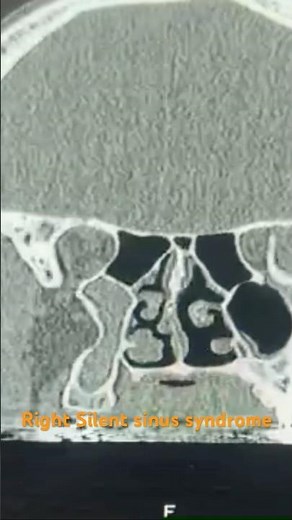 Silent sinus syndrome