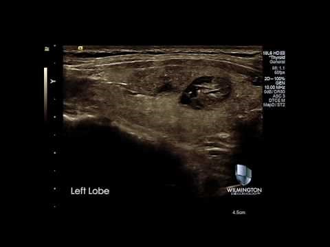 Thyroid Gland with Multiple Nodules