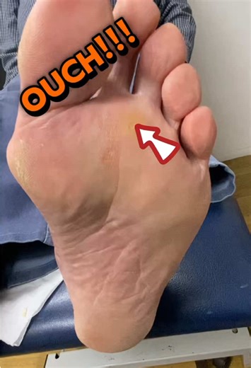 This one’s a nasty, deep corn sitting under the ball of the foot (between toes 2 and 3) — and these are particularly painful because every step drives pressure straight into it. He’s a hardworking bloke in work boots, and you can clearly see the high-pressure wear points from being on his feet all day. Today we carefully removed the corn with a sterile No. 15 scalpel blade to relieve the pressure and get him walking comfortably again. We’ll review in 4 weeks to make sure it stays under control a