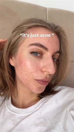 Ana Văideanu on Instagram: "Acne is not “just acne”. it wears down your confidence little by little, and the breakouts don’t just stay on the surface ,they leave scars, both on your skin and on your mindset. people often think it’s something small or temporary, but living with it feels heavier than that. It’s exhausting, it’s frustrating, and it takes strength every single day. Acne isn’t just a skin condition. It’s a whole experience. #acne #mentalhealth #hormonalacne #relatable #viral"