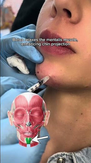 Get more projection in your face and slimmer jaweline with CHIN BOTOX.