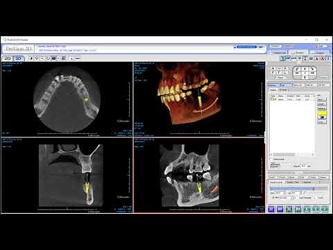 PreXion Training Tips: Virtual Implant Placement, Mandibular Canal Tracing