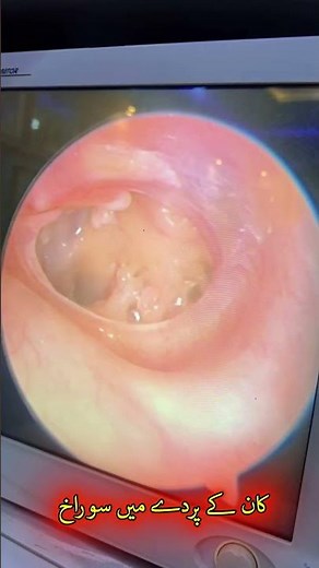 Perforated Eardrum: Causes, Symptoms, and Effective Treatment