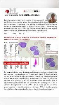 Complete Blood Count in Acute Leukemia #7: Are they really neutrophils? APL #hematology #medicine